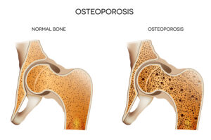 Elder Care Gettysburg PA - Easy Things Seniors Can Do To Prevent Osteoporosis